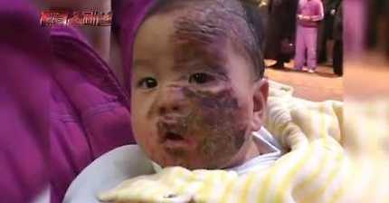 끓는 기름에 아기 얼굴이 빠졌는데 병원으로 안 가고 교회(?)에 기도하러 간 부모 (아가 화상입은 얼굴 있어ㅠㅠ) | 인스티즈