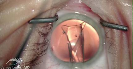 Visian ICL: High Definition Intraocular Contact Lens