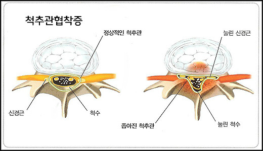 척추관협착증 치료방법 알려주세요
