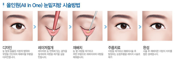 눈밑지방제거 비용과 눈밑지방 없애는 법 좀 알려주세요~~