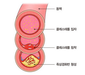 저밀도 콜레스테롤