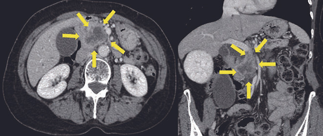 복부 CT 검사에서 관찰되는 췌장의 종양