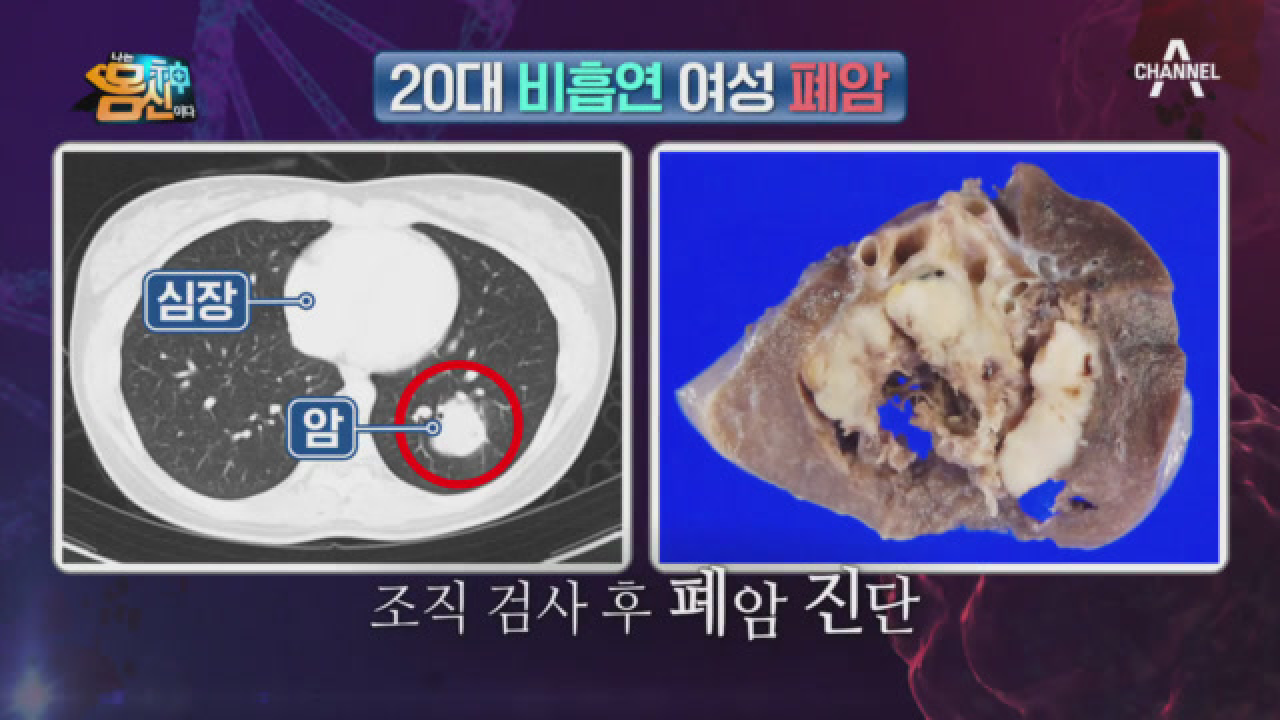 비흡연자도 피하지 못하는 폐암! 흡연자와 비흡연자의 폐암 발견 위치가 다르다?