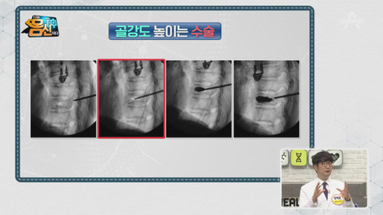 골다공증에 걸려도 뼈가 안부러지는 방법이 있다?! ▶뼈 시멘트◀