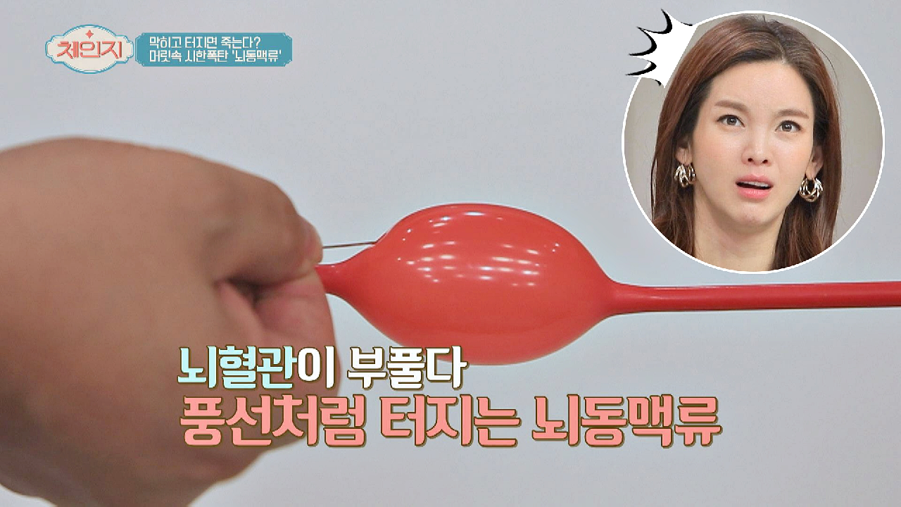 ※뇌졸중 주의보※ 머릿속 풍선 &#39;뇌동맥류&#39;를 조심하라..!