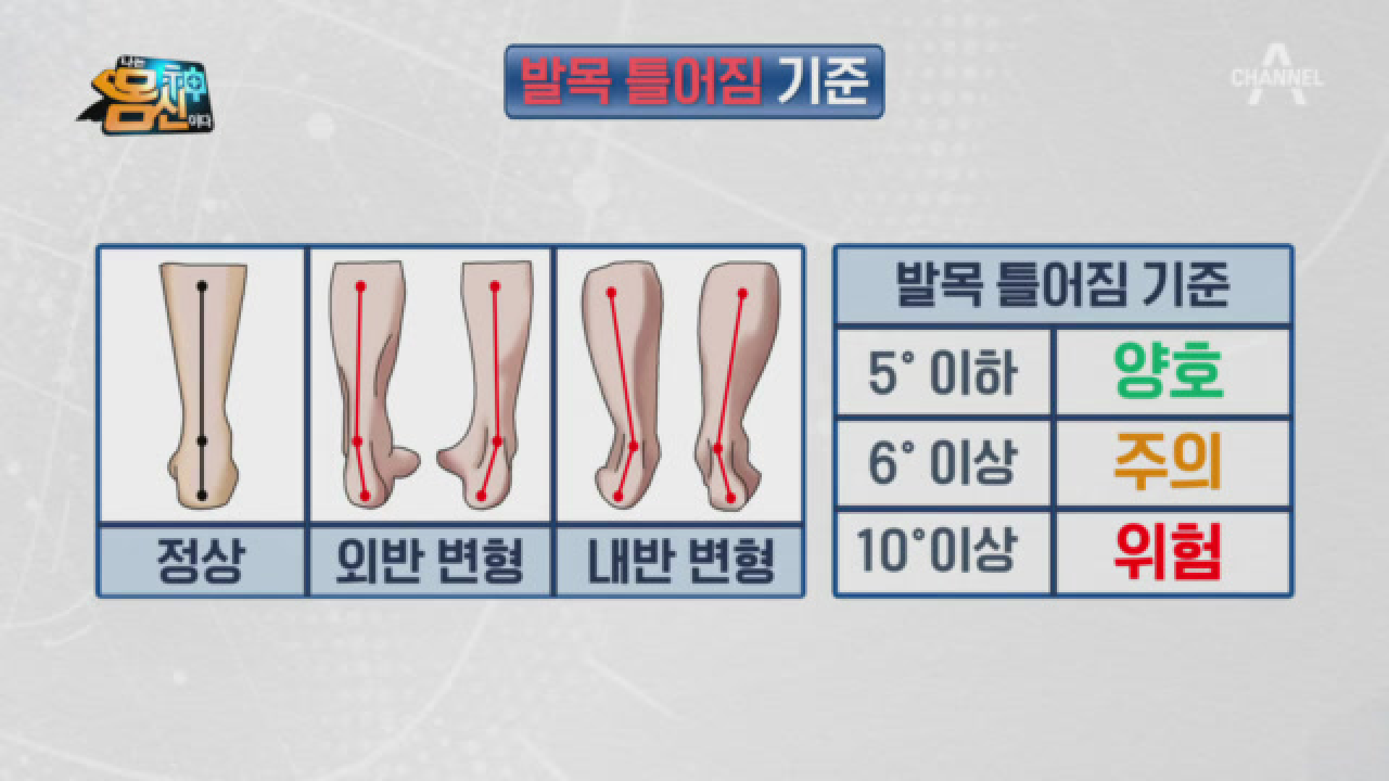 발목을 접질리며 생긴 혈전이 &#39;OO&#39;을 초래했다?!