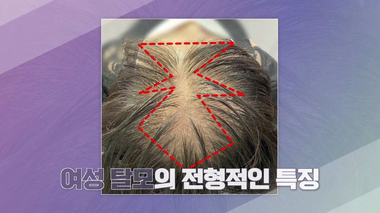 삐빅- 탈모입니다. ＜머리가 보내는 탈모 시그널＞ - kakaoTV 삐빅- 탈모입니다. ＜머리가 보내는 탈모 시그널＞