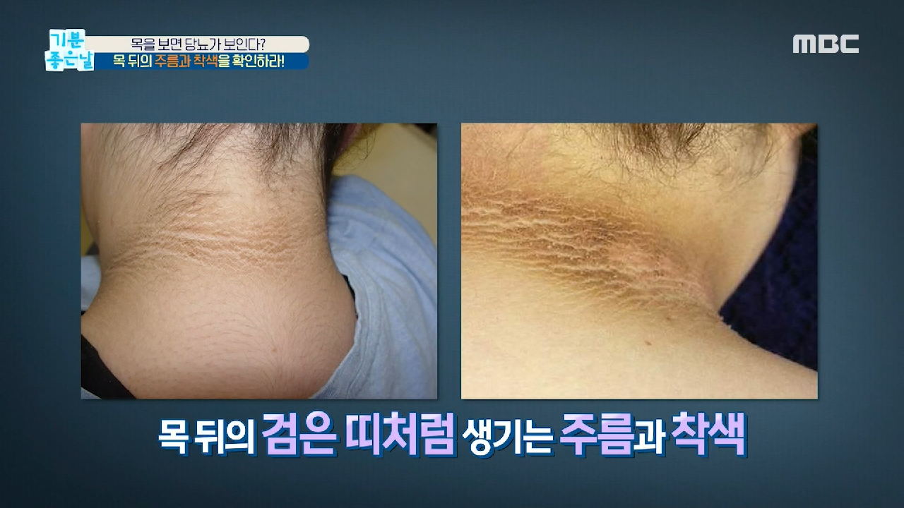 목 뒤의 ＜주름과 착색＞을 확인하라! MBC 200925 방송 - kakaoTV 목을... 목 뒤의 ＜주름과 착색＞을 확인하라! MBC 200925 방송