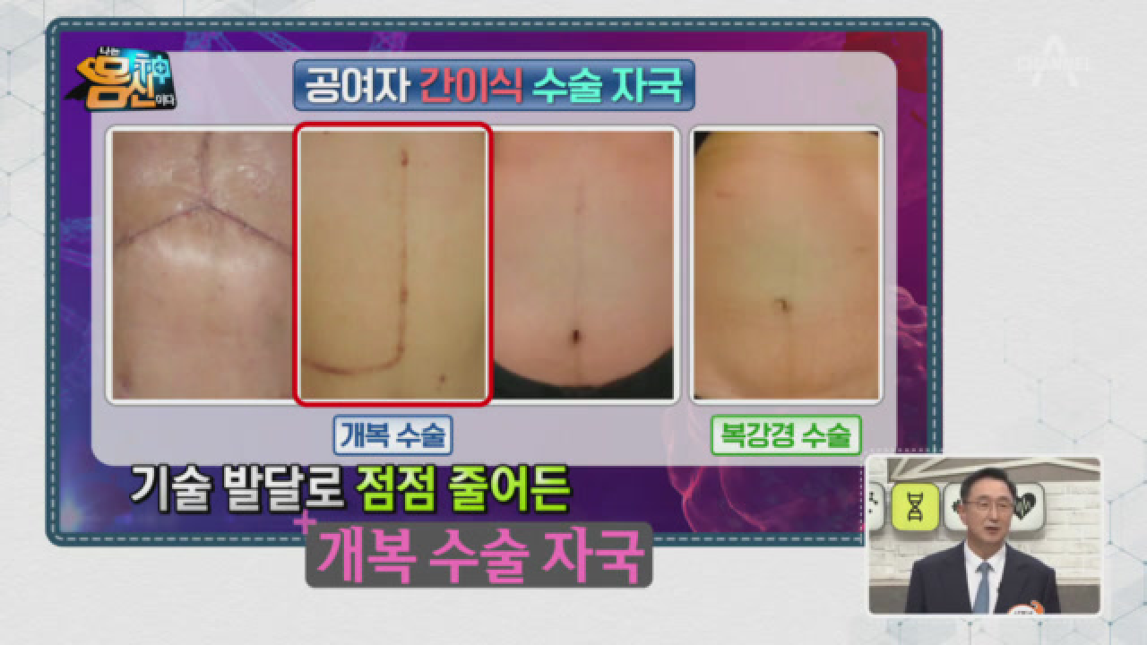 간이식 공여자는 30%의 작은 간으로 평생을 살아야 한다?