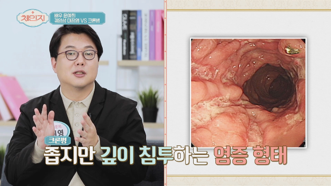 심하면 대장 절제까지?! 장 건강 무너지면 생기는 &#39;크론병&#39; | JTBC 210505 방송
