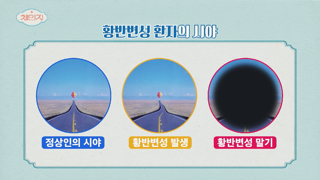 최악의 경우 실명까지 갈 수 있는 &#39;황반변성&#39; (ft. 주사?) | JTBC 210421 방송