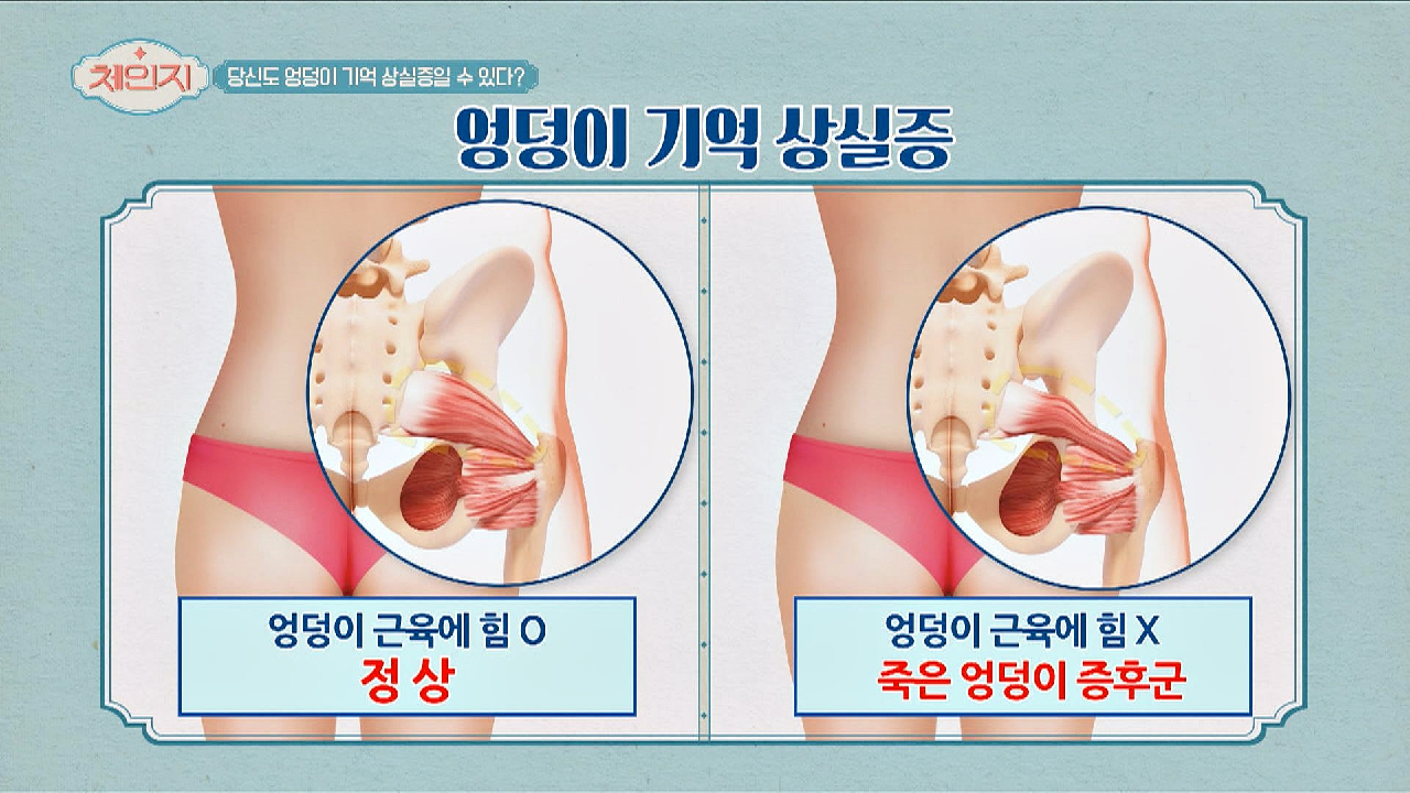 엉덩이의 근육을 쓰지 않으면 걸리는 &#39;엉덩이 기억상실&#39;