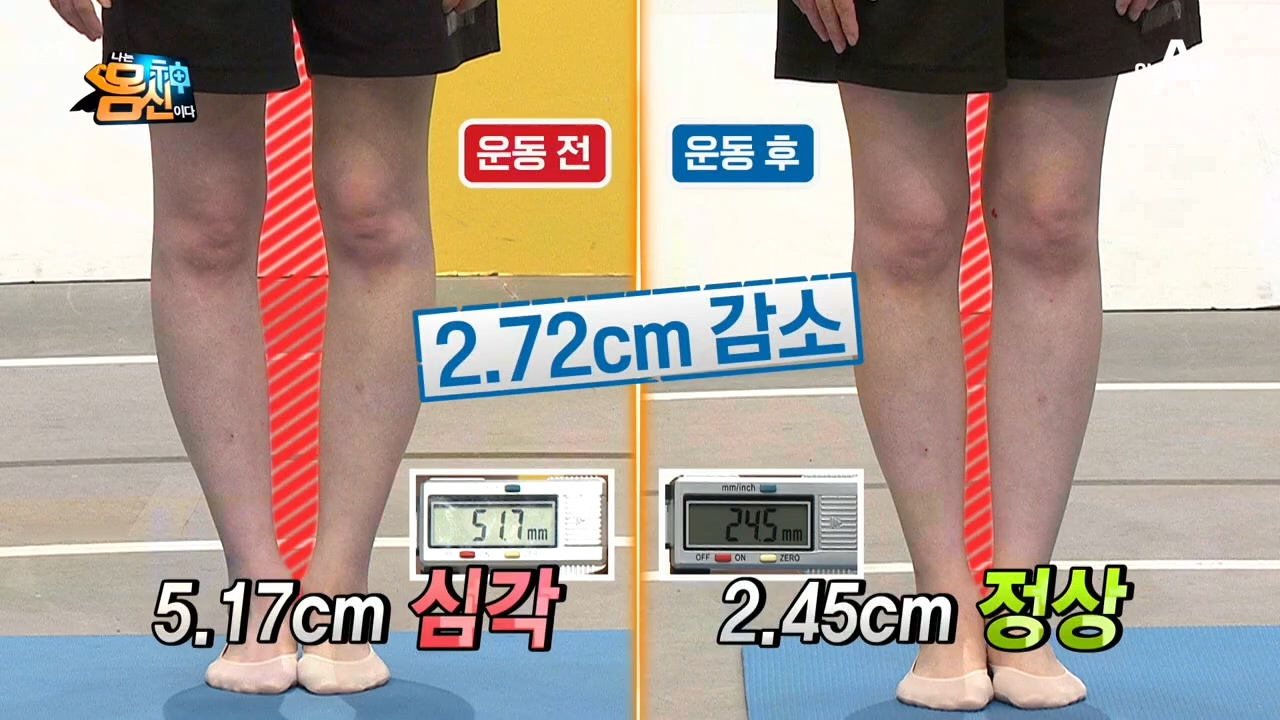 (입이 떡-) 페트병 운동 후 사례자 무릎의 변화는?