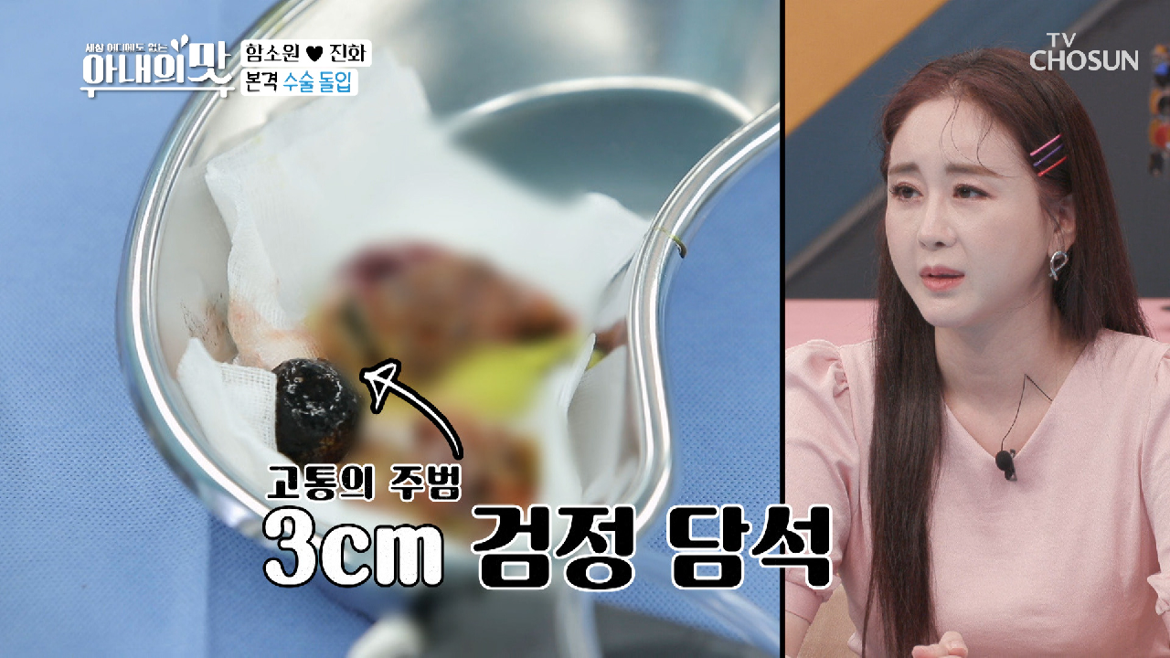 의사도 인정한 마마 담석 크기..ㄷㄷ