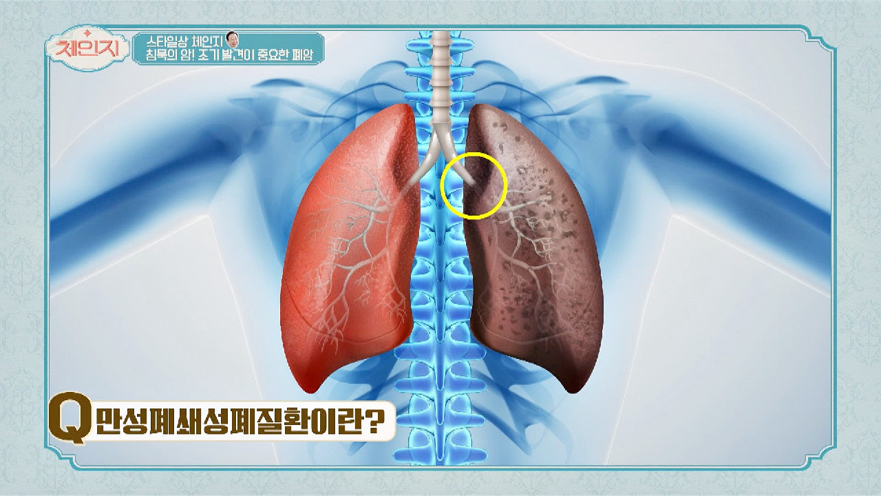 ? 세계 사망원인 4위 &#39;만성폐쇄성폐질환&#39;이란?