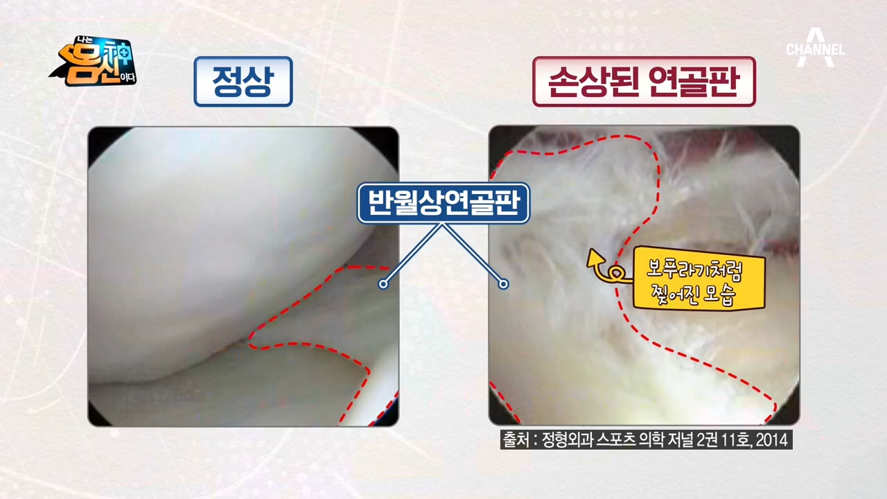 어린 나이에도 반월상연골판이 닳을 수 있다?!