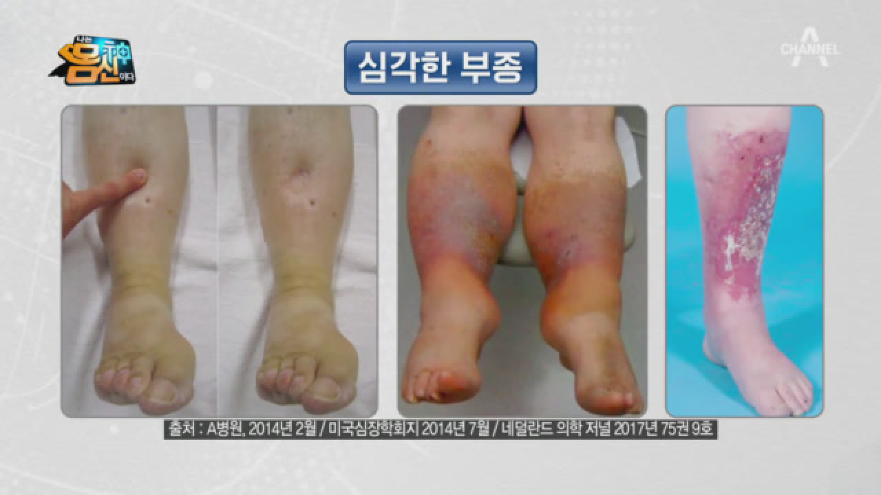 그냥 두면 싹~ 다 살이 되고 심하면 절단까지? 부종도 급성이 있다?