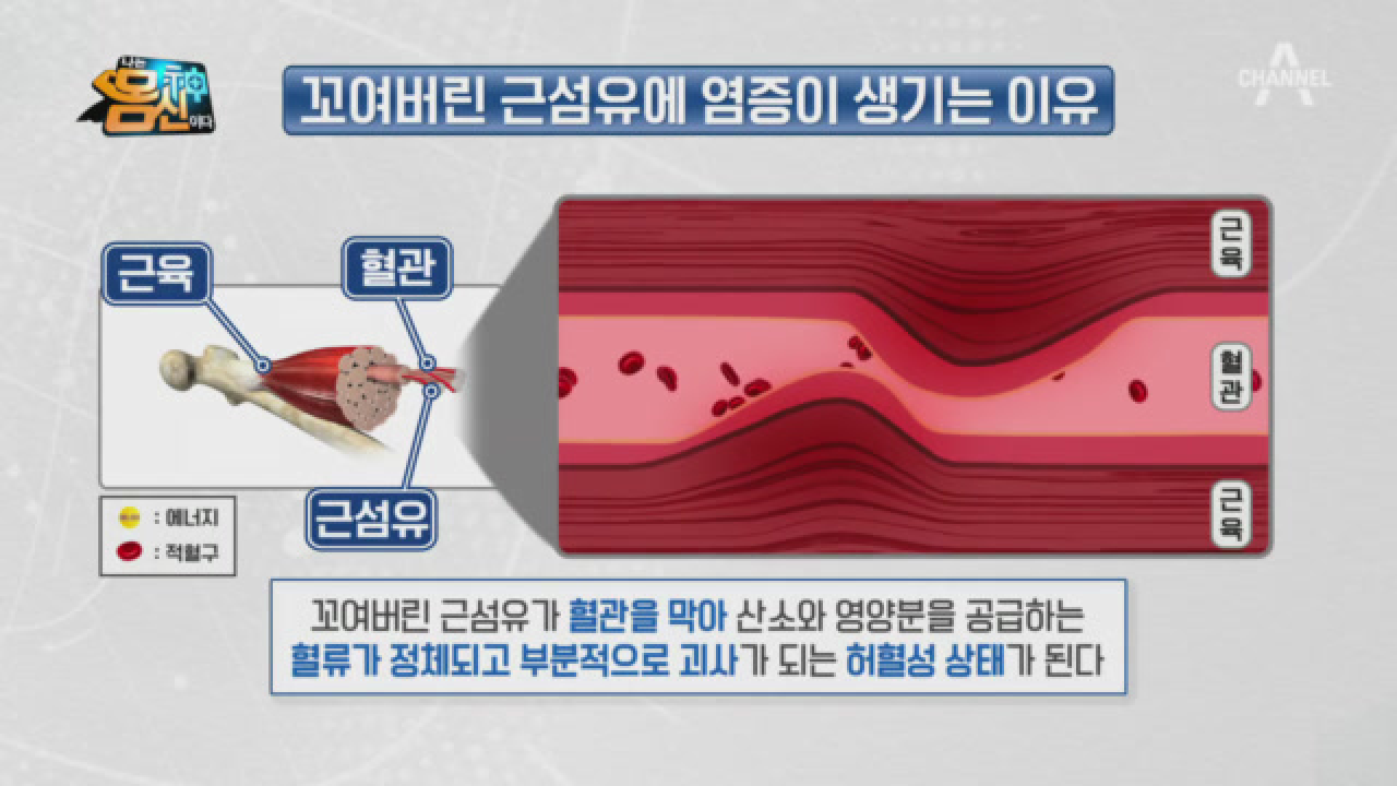 꼬여버린 근육에서 생긴 염증이 통증을 유발한다?!