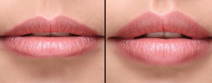 입꼬리 성형수술 관련 의료사고에 관한 FAQ와 대응방법