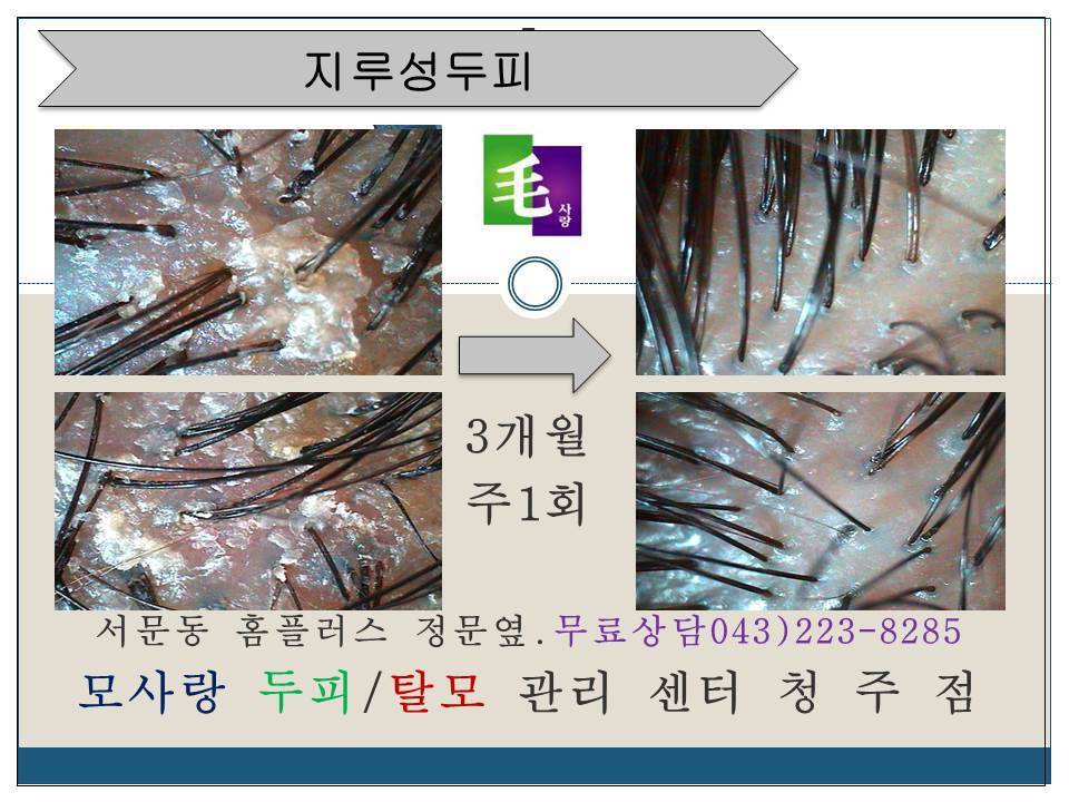 [청주탈모][청주두피관리] 청주두피관리의 명가 모사랑 - 탈모예방법 - 메이리스칼프 두피탈모관리전문센터 [청주탈모][청주두피관리]... 