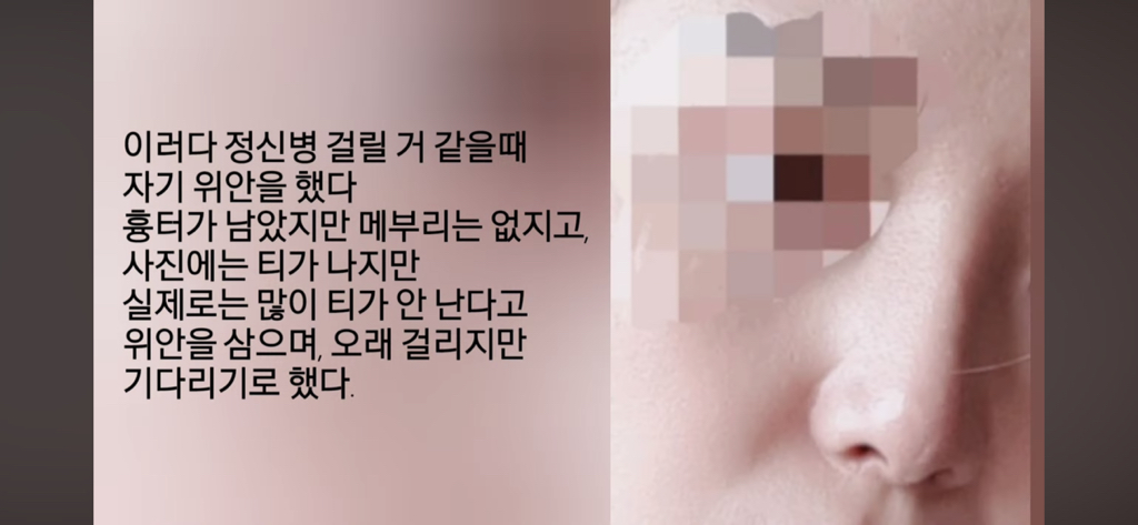 코수술 부작용으로 인한 코끝 꺼짐 + 자가진피 코수술 후기 | 인스티즈