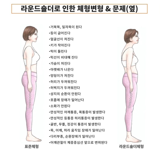 라운드숄더로 인한 체형 변형 앞&뒤&옆 | 인스티즈