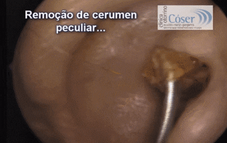 귀지 제거 .gif | 인스티즈