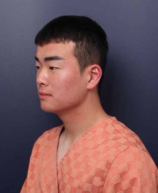 남자 성형 전후 눈+코+매부리교정 | 인스티즈