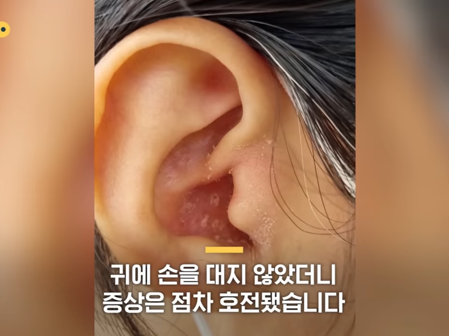 [SBS뉴스] "귓밥 못 참고 팠는데…” 상상도 못할 곳에 퍼졌다 | 인스티즈