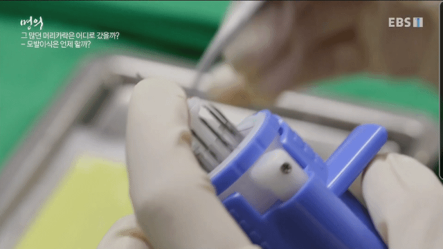 (주의) 실제 모발이식 장면.gif | 인스티즈