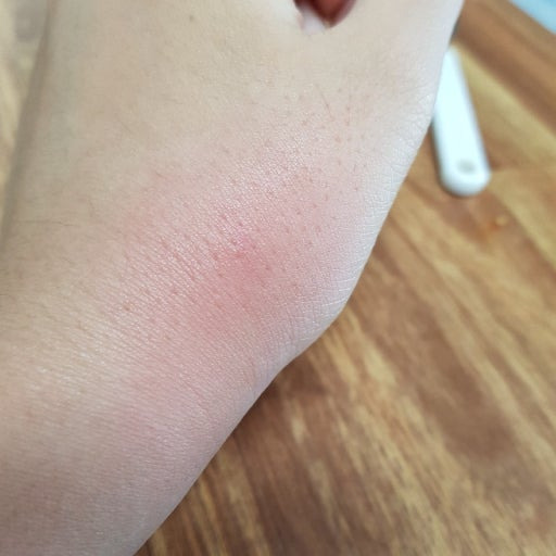 모기 물리면 개 크게 물리는 사람들 | 인스티즈