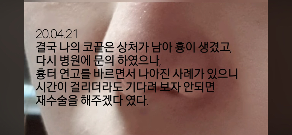 코수술 부작용으로 인한 코끝 꺼짐 + 자가진피 코수술 후기 | 인스티즈