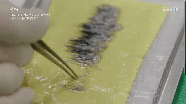 (주의) 실제 모발이식 장면.gif | 인스티즈