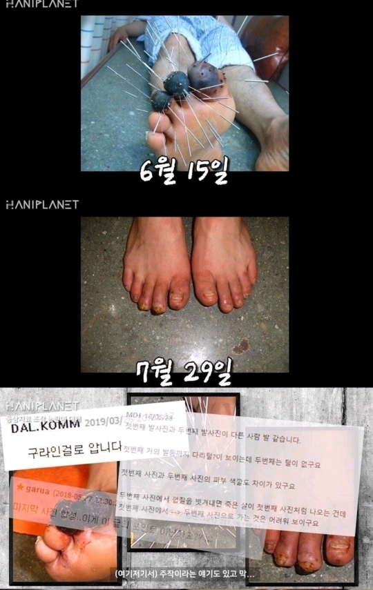 한의원 동상 치료 논란 본인 인터뷰.jpg | 인스티즈