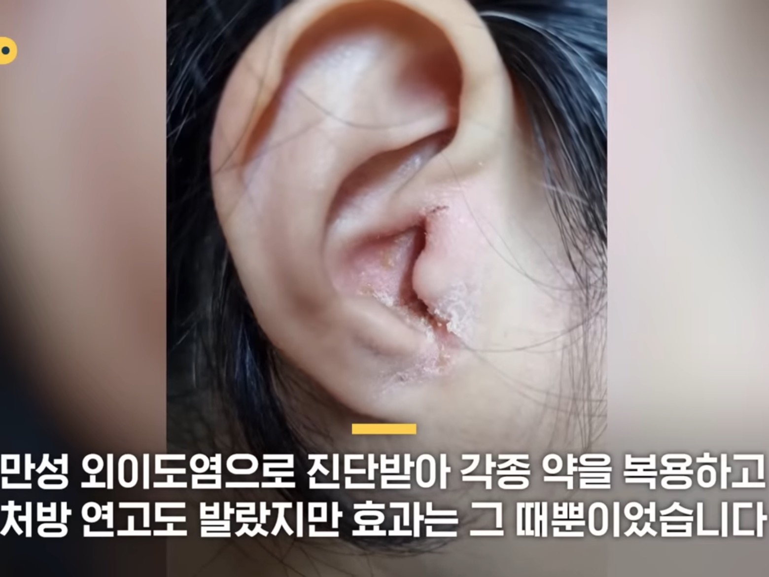 [SBS뉴스] "귓밥 못 참고 팠는데…” 상상도 못할 곳에 퍼졌다 | 인스티즈