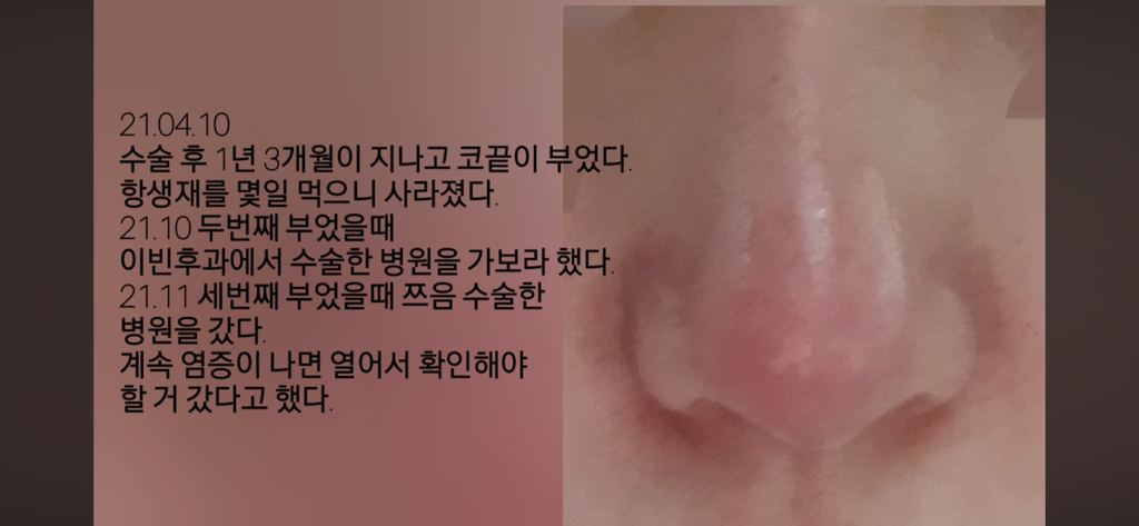 코수술 부작용으로 인한 코끝 꺼짐 + 자가진피 코수술 후기 | 인스티즈