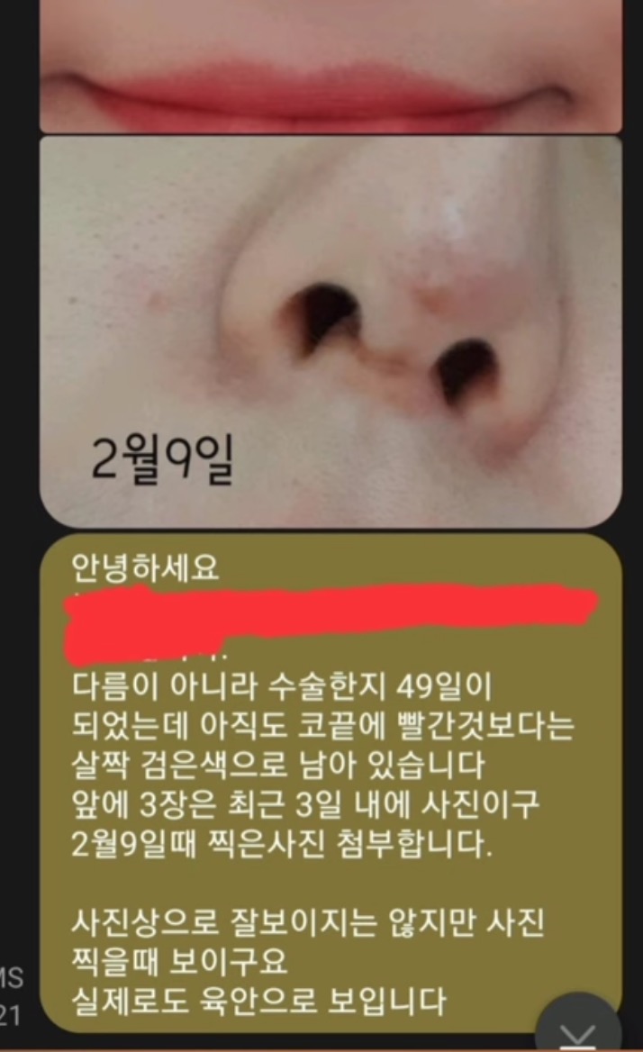 코수술 부작용으로 인한 코끝 꺼짐 + 자가진피 코수술 후기 | 인스티즈
