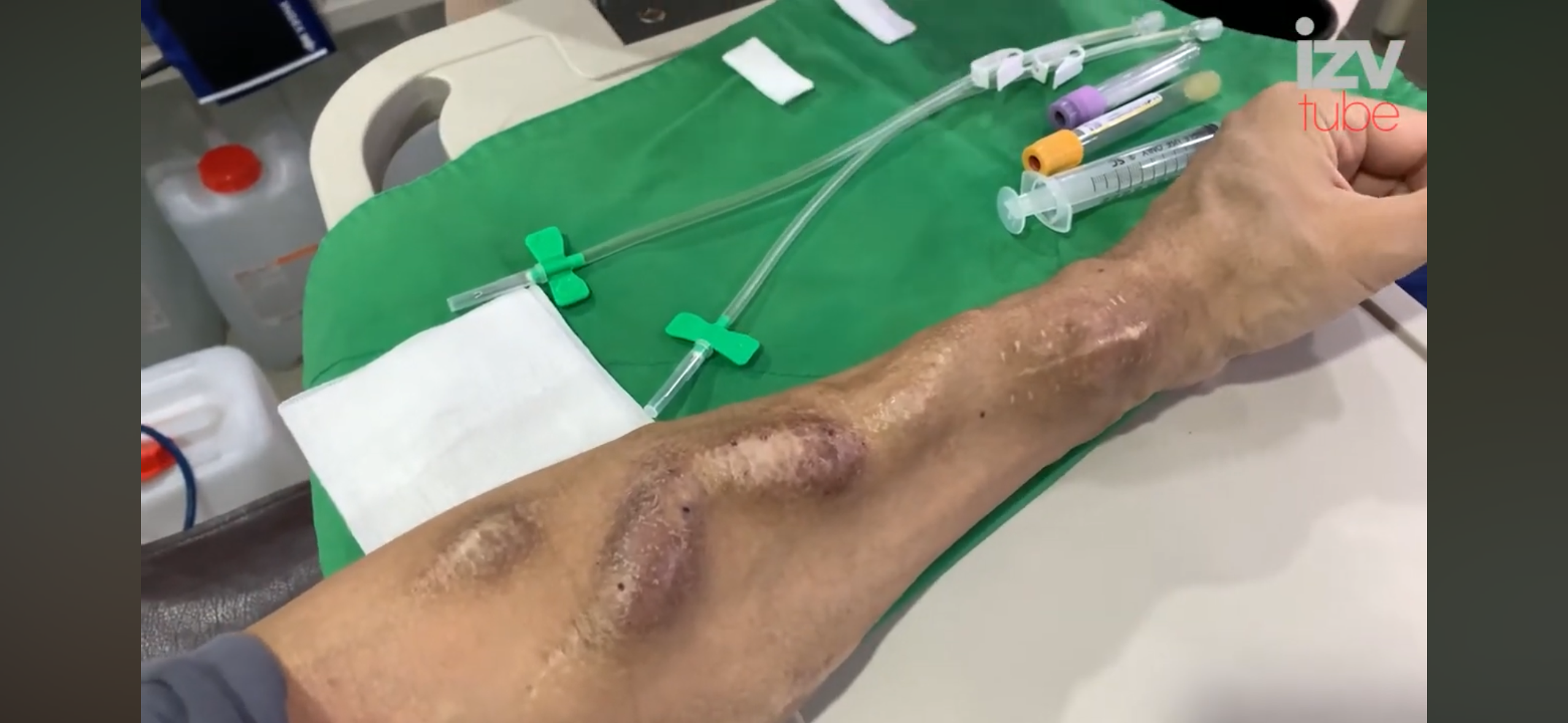 신장 투석용 바늘 굵기 | 인스티즈