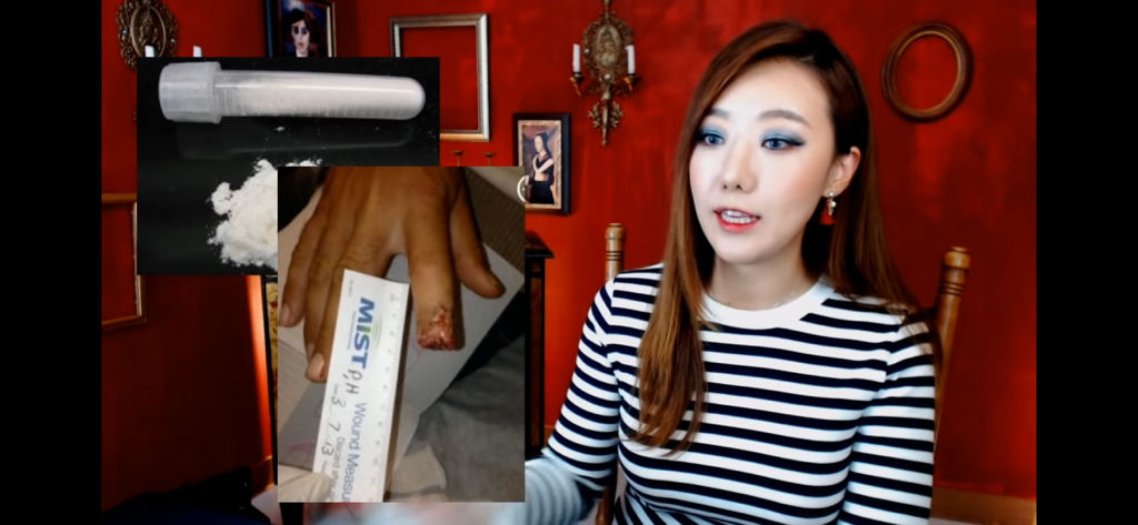 돼지 방광으로 잘린손가락 재생사례(손가락사진 주의) | 인스티즈