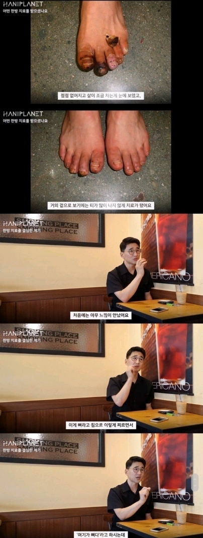 한의원 동상 치료 논란 본인 인터뷰.jpg | 인스티즈