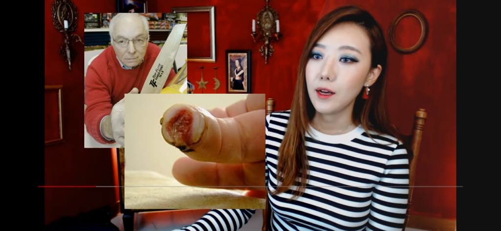 돼지 방광으로 잘린손가락 재생사례(손가락사진 주의) | 인스티즈