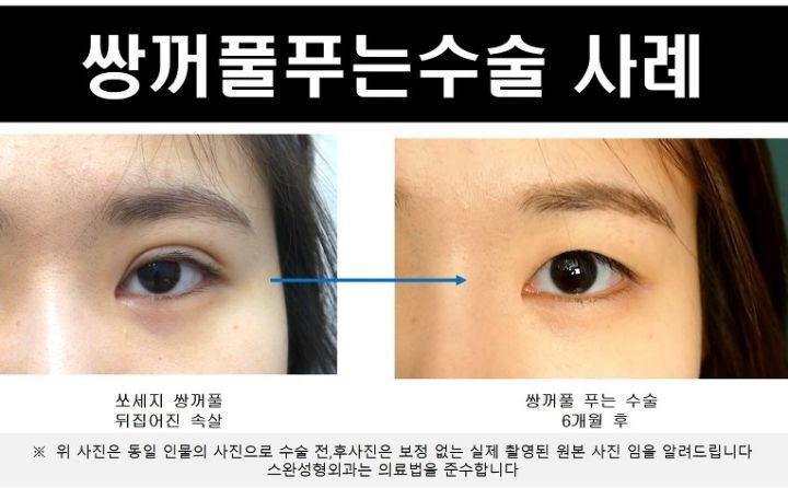 모르는 사람이 많다는 쌍커풀 푸는 수술 | 인스티즈