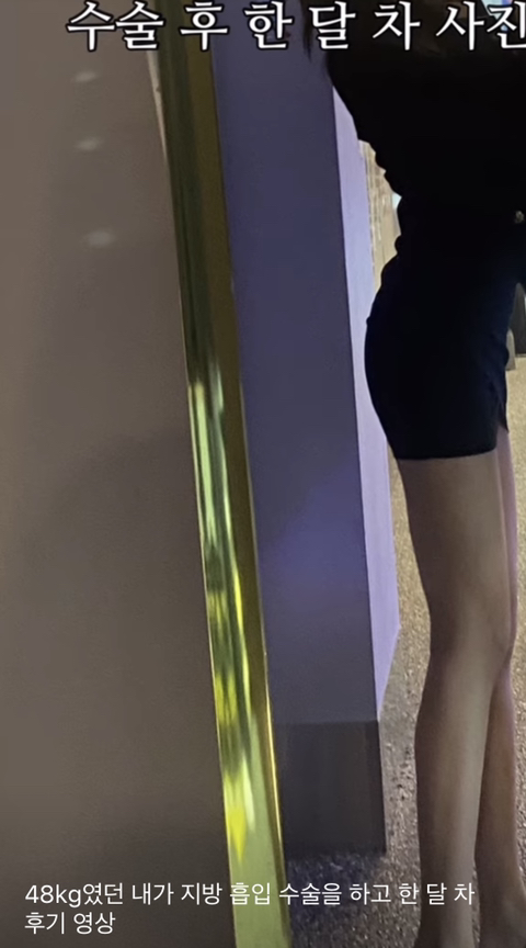 아니 유튜브 보는데 48kg가 지흡 수술을 하네... | 인스티즈