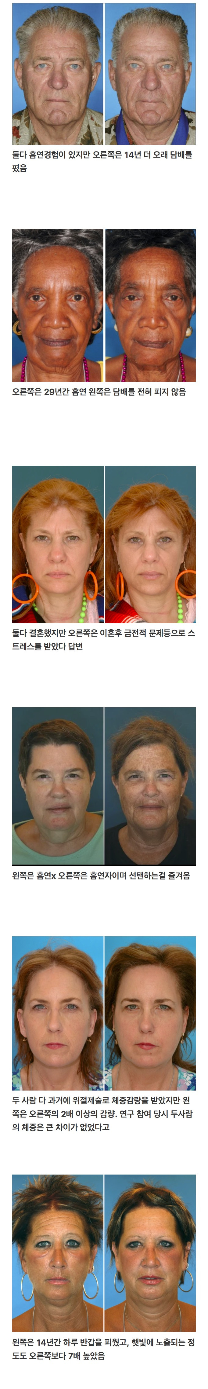 일란성 쌍둥이로 비교한 노화 - 담배, 스트레스, 햇빛, 체중변화.jpg | 인스티즈