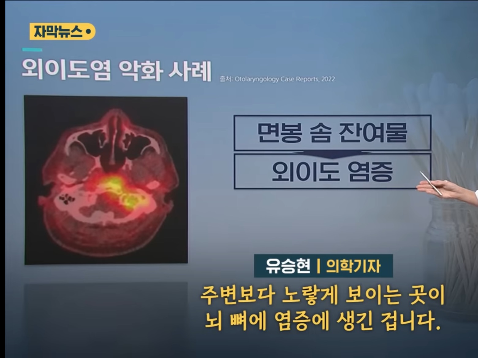 [SBS뉴스] "귓밥 못 참고 팠는데…” 상상도 못할 곳에 퍼졌다 | 인스티즈