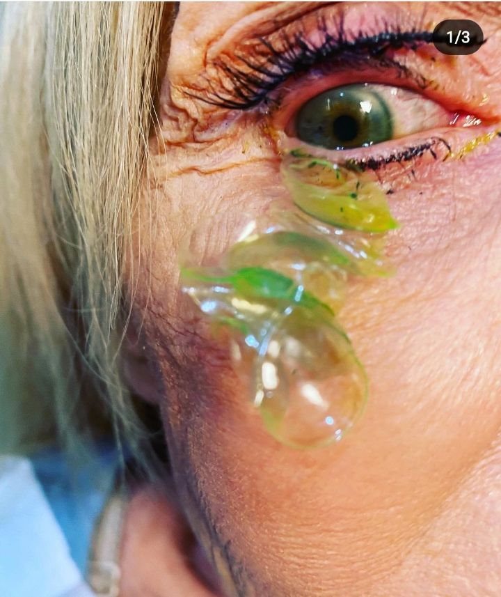 (혐오주의) 눈 한쪽에서 콘택트 렌즈 23개 돌아다녔던 사례...gif | 인스티즈