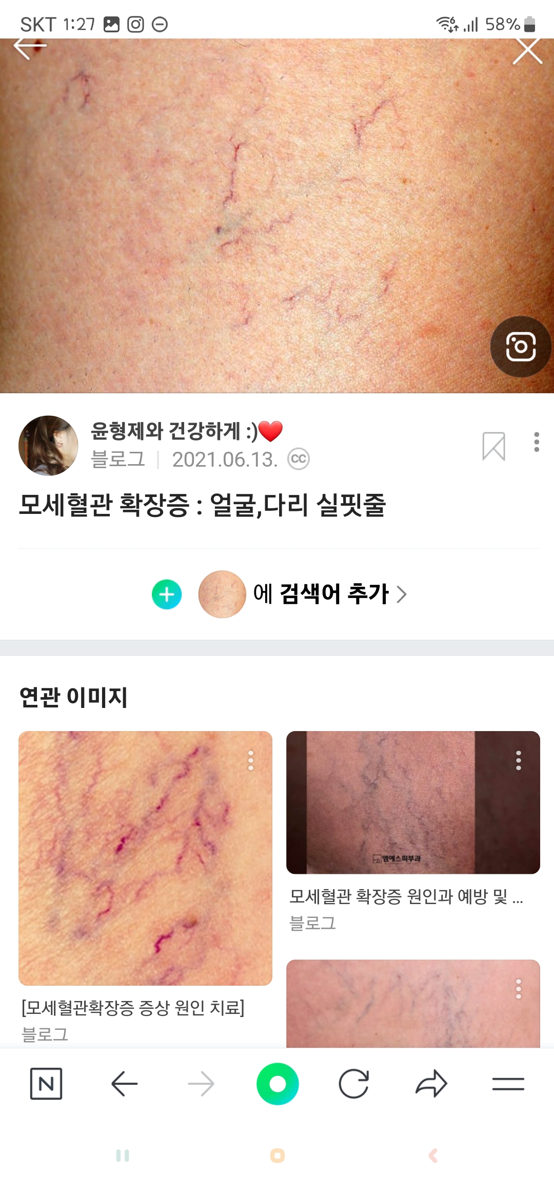 다리에 얇은 핏줄이 보여요!모세혈관확장증 | 인스티즈