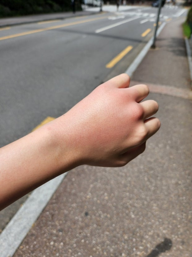 모기 물리면 개 크게 물리는 사람들 | 인스티즈