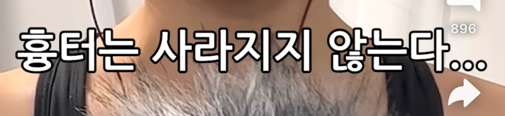 코수술 부작용 이야기 + 댓글 부작용 후기 | 인스티즈