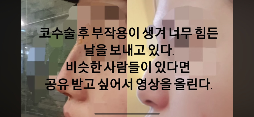 코수술 부작용으로 인한 코끝 꺼짐 + 자가진피 코수술 후기 | 인스티즈